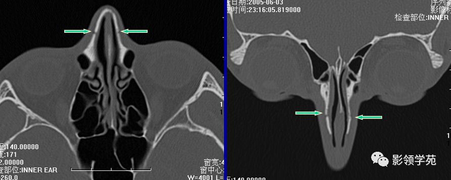 鼻骨影像学解剖,鼻骨解剖及骨折影像学诊断