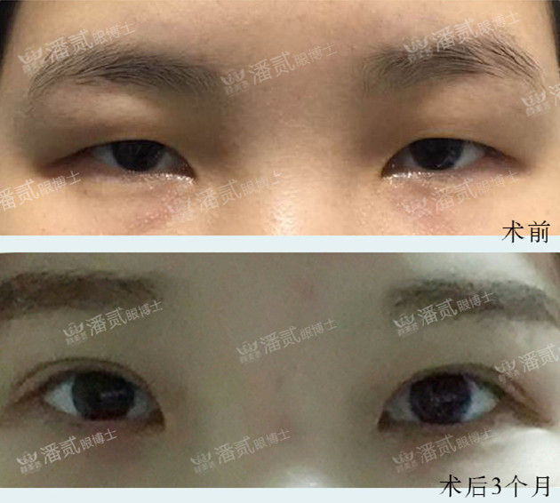 割双眼皮和眉骨有关系吗,做双眼皮想要圆眼割什么样的