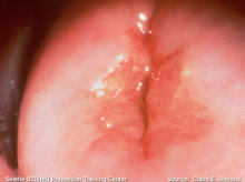 宫颈糜烂是病吗需要治疗吗,宫颈糜烂的解释