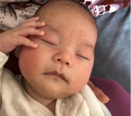 湿疹、痱子、小儿急疹傻傻分不清楚？一篇文章搞定！