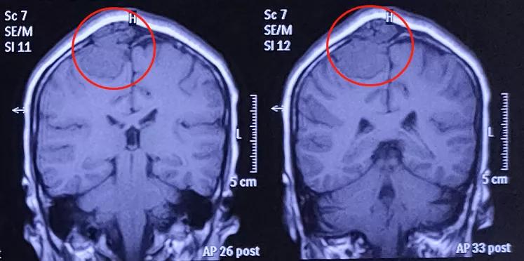 侵蚀颅骨的脑瘤是不是良性,脑膜瘤颅骨侵蚀后怎么办