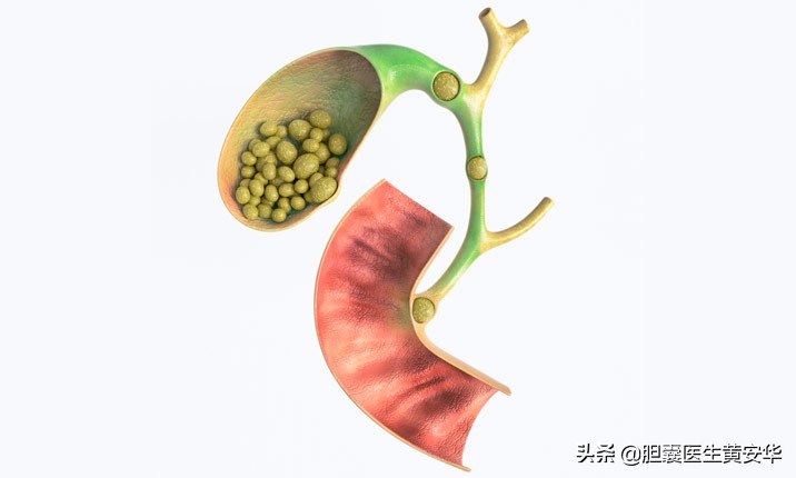 吃什么水果容易导致胆结石,喝苹果汁真的能排出胆结石吗