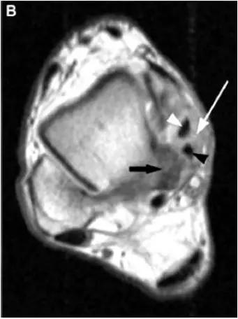 踝关节撞击症问诊,踝关节撞击综合征的x线表现