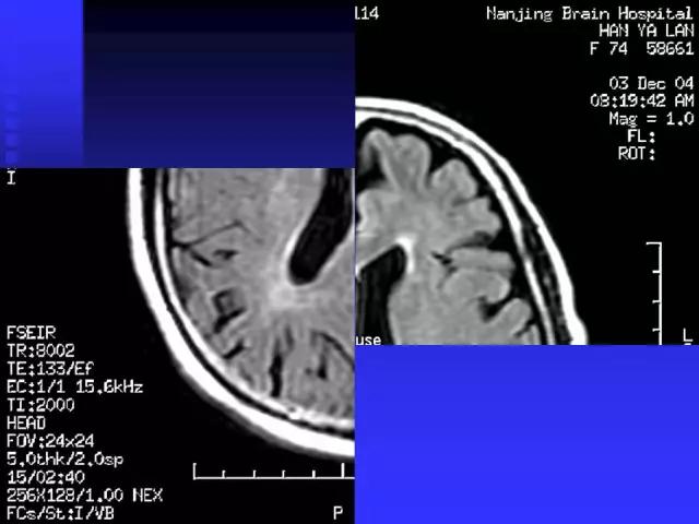 头颅mri读片视频教程,颅脑mri读片入门教程视频讲解全集