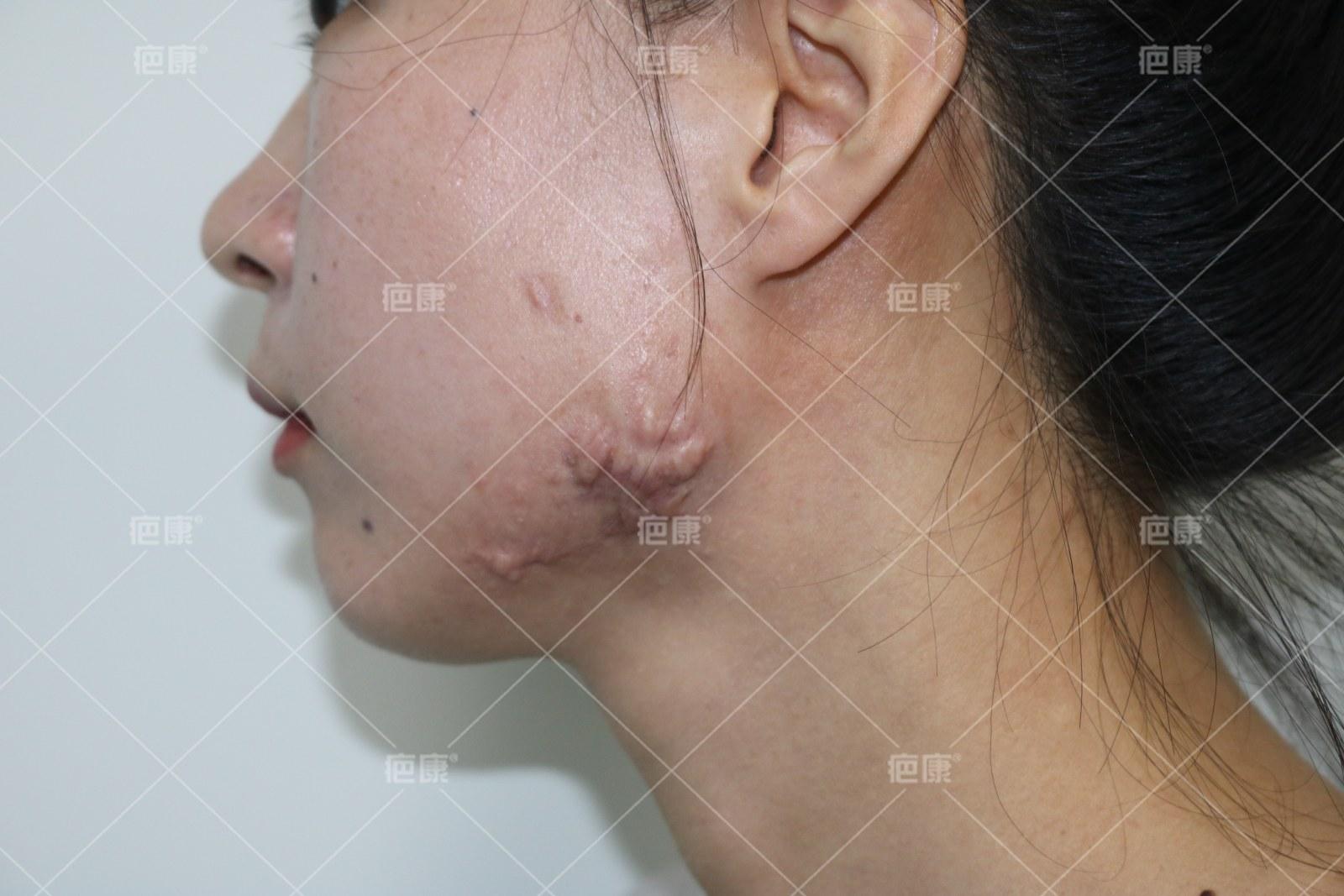 北京疤康对疤痕疙瘩能看好吗,疤康疤痕疙瘩恢复图片