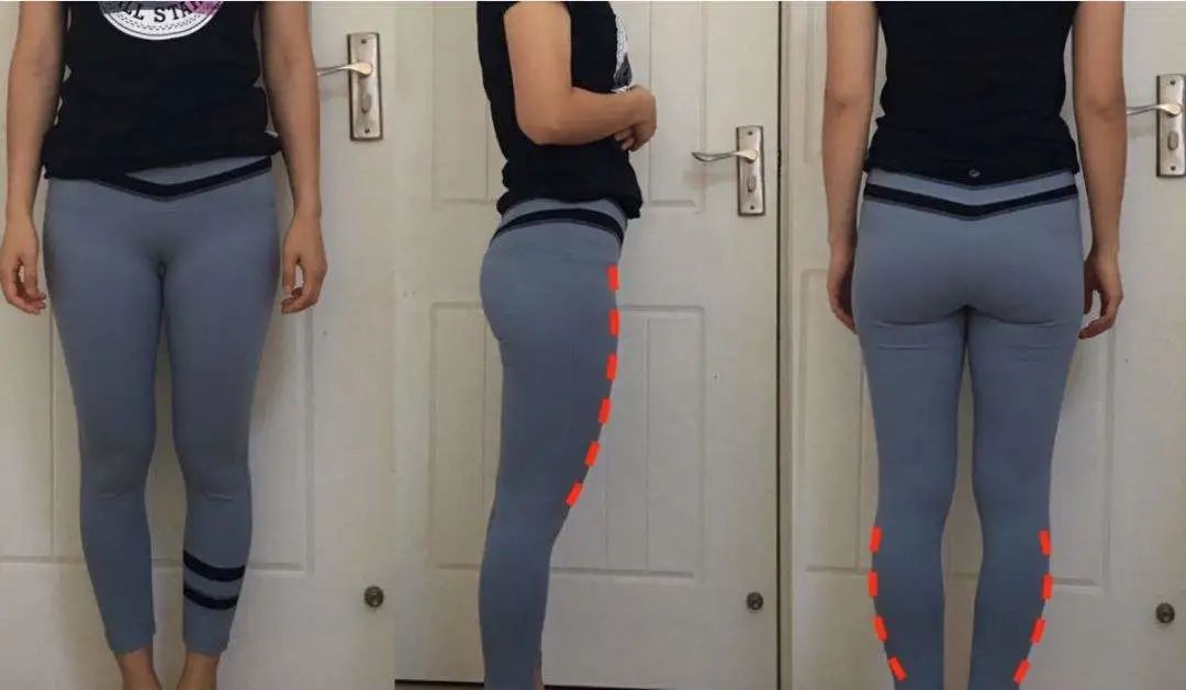 膝超伸腿粗运动可以改善吗,大粗腿膝超伸矫正方法图解