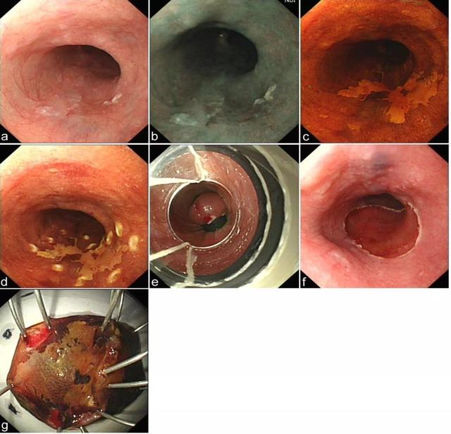 食管癌诊疗规范（2018年版）