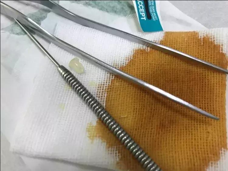 小孩耳朵长肉芽是什么原因引起的,耳朵里长了个肉芽怎么回事