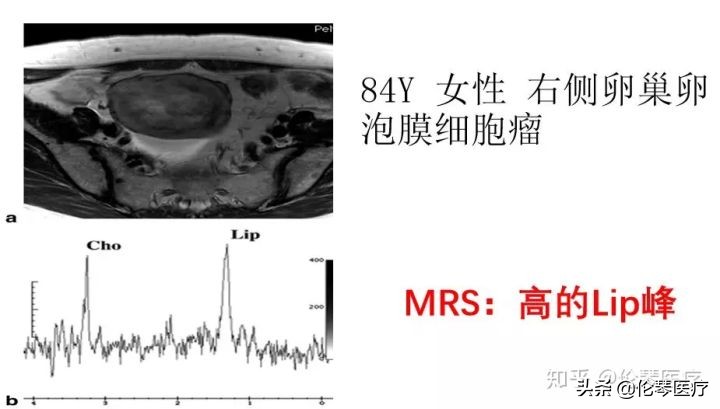 卵巢肿瘤核磁共振能看出来吗,超声测出来肿瘤