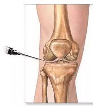 膝关节磁共振如何识别半月板损伤,磁共振半月板越来越严重怎么回事