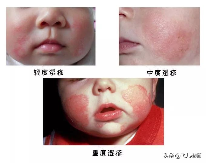 小孩长湿疹用什么方法最好,小孩起湿疹的最佳治疗办法