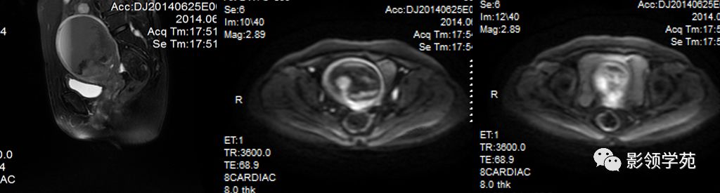 宫颈癌mri诊断,宫颈癌的mr扫描技术