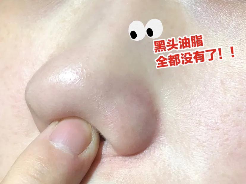 黑头终结者！攒了15年黑头连根拔起，鼻子比钱包还干净