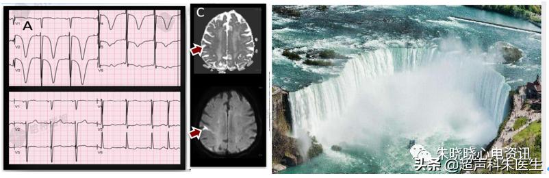 t波倒置诊断,t波倒置如何区分严重程度