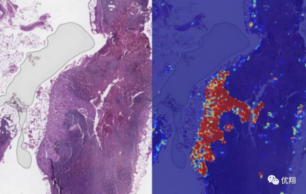 谷歌AI医疗放大招:将转移性乳腺癌检测准确率推向99%!