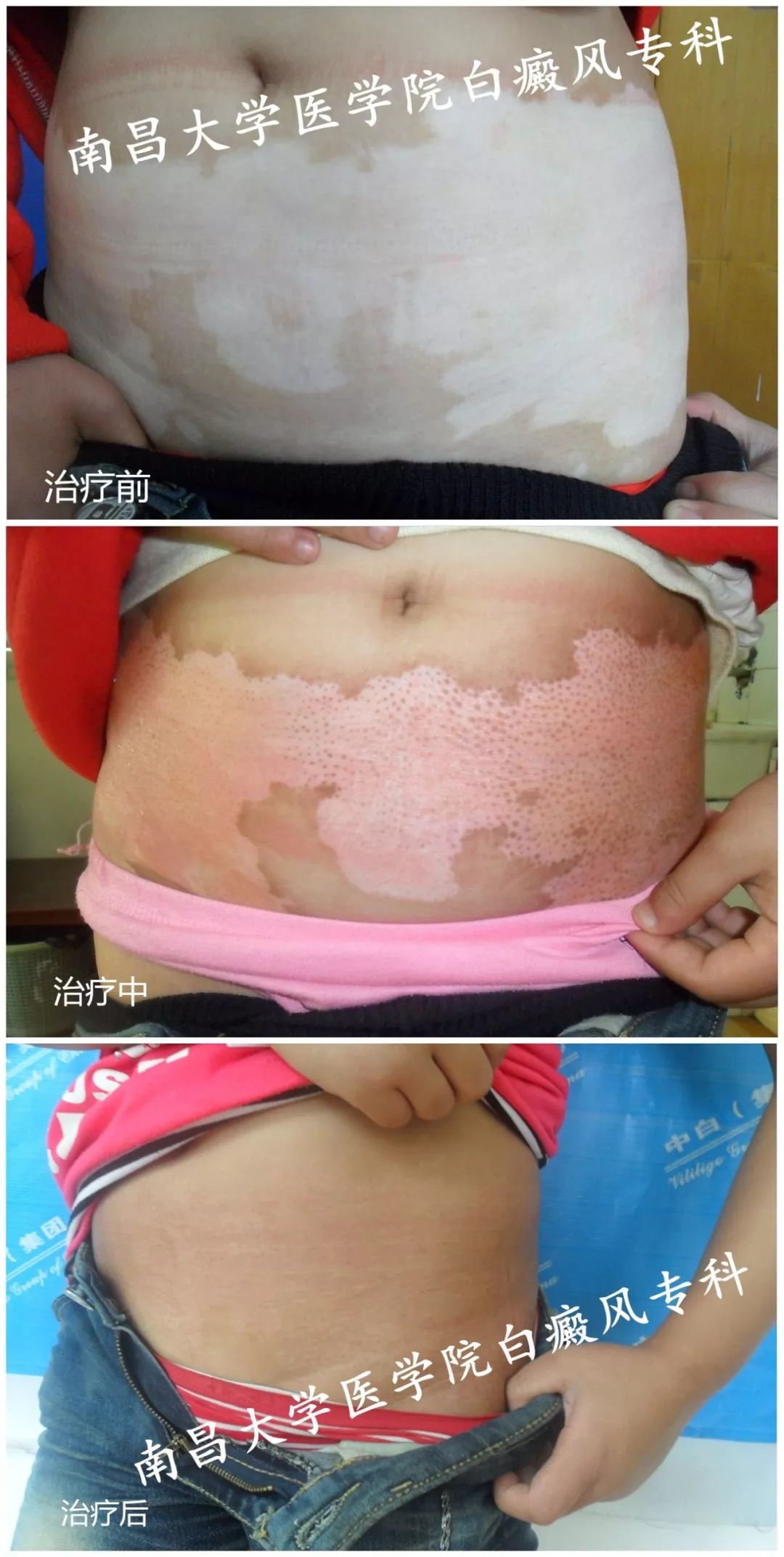 官宣：这么高规格的白癜风会诊，您还不来？20～22日，张洪冰教授与您相约，仅限三天！