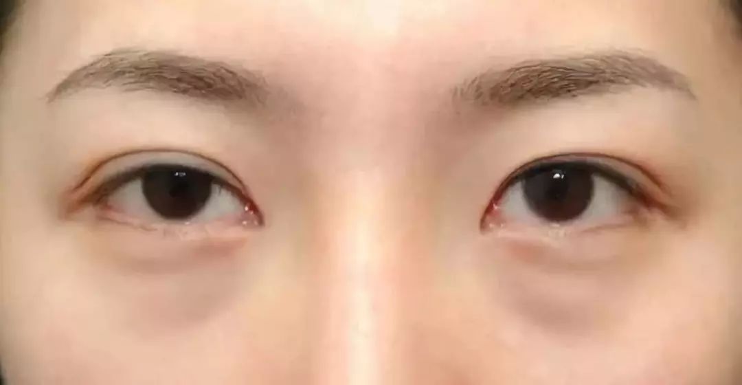 430年马应龙非遗中药眼膜，保密古方，一敷秒去大眼袋