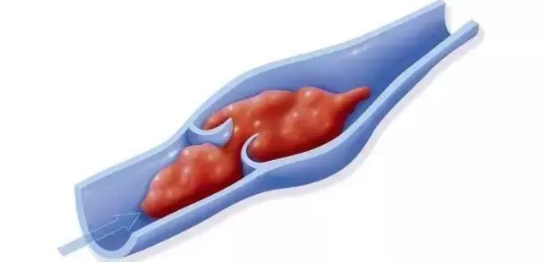 腹膜后肿瘤导致下肢水肿怎么办,肿瘤引起下肢水肿怎么治疗