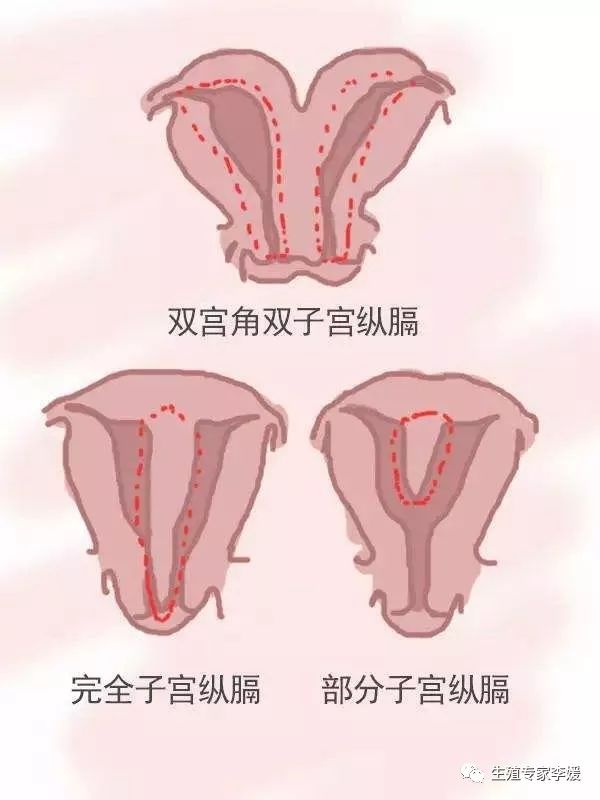 子宫畸形可以试管吗,子宫发育畸形能做试管吗