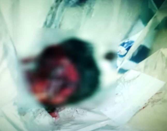 有头发、有牙齿、有颅骨!17岁女高中生肚里长了个奇怪的肿瘤,似怀孕!这类肿瘤女性生殖系统常见!