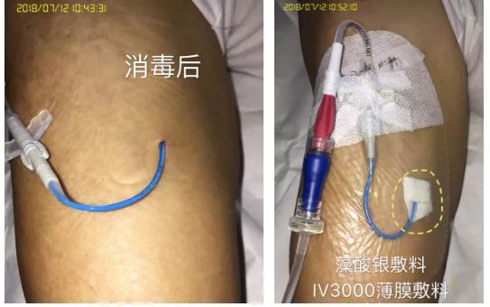 picc穿刺处渗血的预防和处理,picc穿刺部位渗血图片