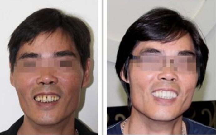 哪十家医院种植牙享受补贴,缺牙市民可申请免费种牙