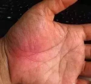 手上这块肉一看就知身体好不好,手掌上这块肉身体问题一看就知道