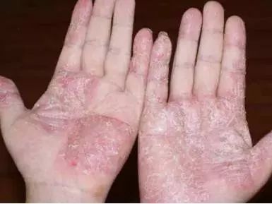 泰国治癣的药膏排行榜,泰国治疗皮肤癣的药膏