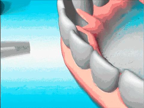 男子查出严重梅毒,男子被查梅毒后续