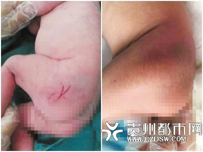 新生儿臀部“被划三刀”？家属同意医疗纠纷委员会介入调解