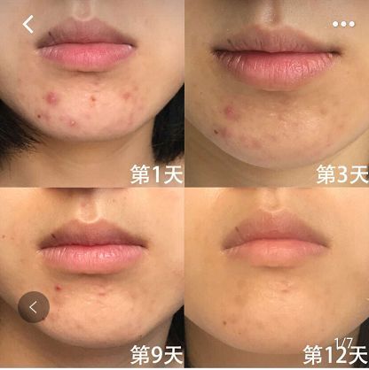 推荐的祛痘面膜青春期,祛痘紧急修复面膜