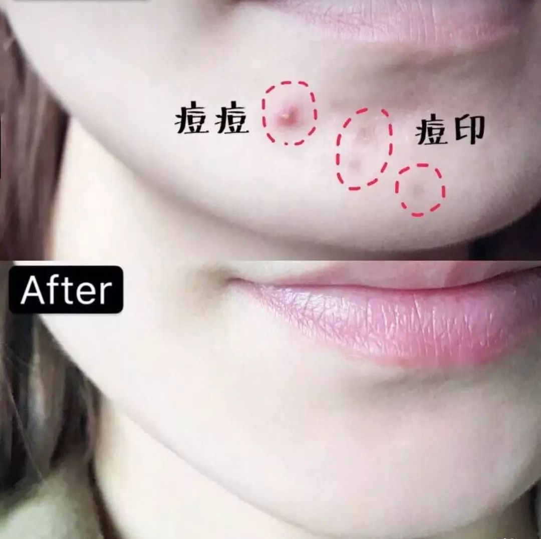 红肿,流脓的万年毒痘一喷全消失?岛国新晋痘肌终结者!彻底祛痘不反复!
