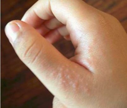 涓尰鎵嬫寚闀挎按娉＄棐,涓尰杈ㄨ瘉鎵嬩笂闀垮皬姘存场寰堢棐