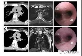 唐都医院支架手术怎么样,唐都医院气管支架
