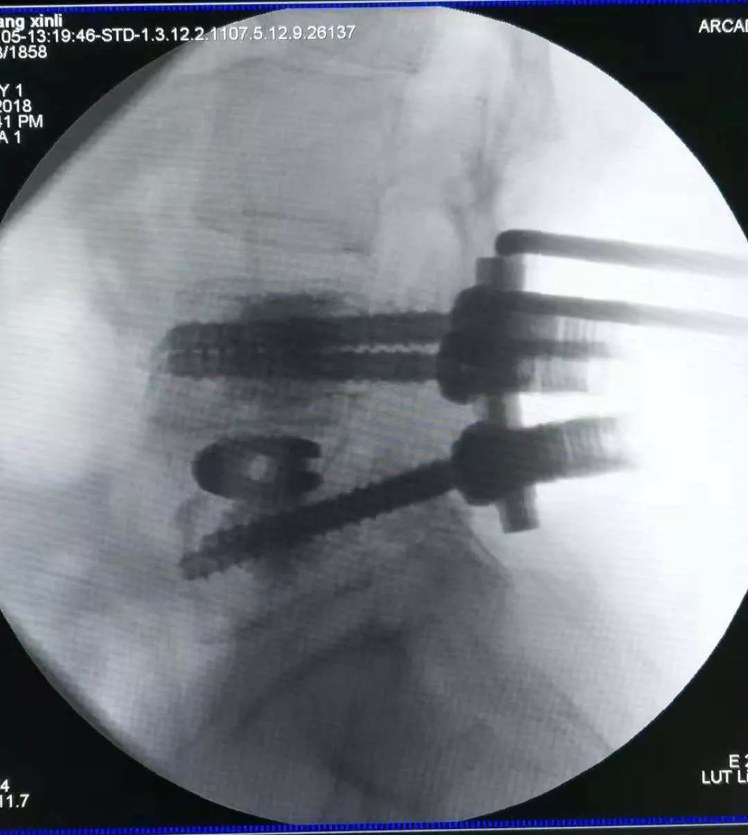 骨水泥治疗老年压缩性腰椎骨折,骨水泥治疗骨质疏松脊柱骨折