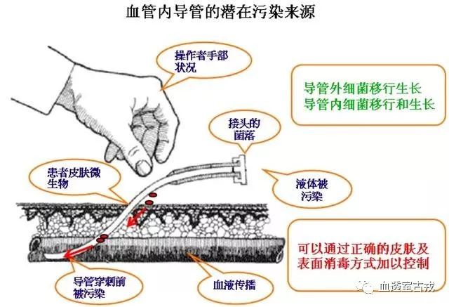 中心静脉导管使用方法视频,中心静脉导管护理技术操作标准