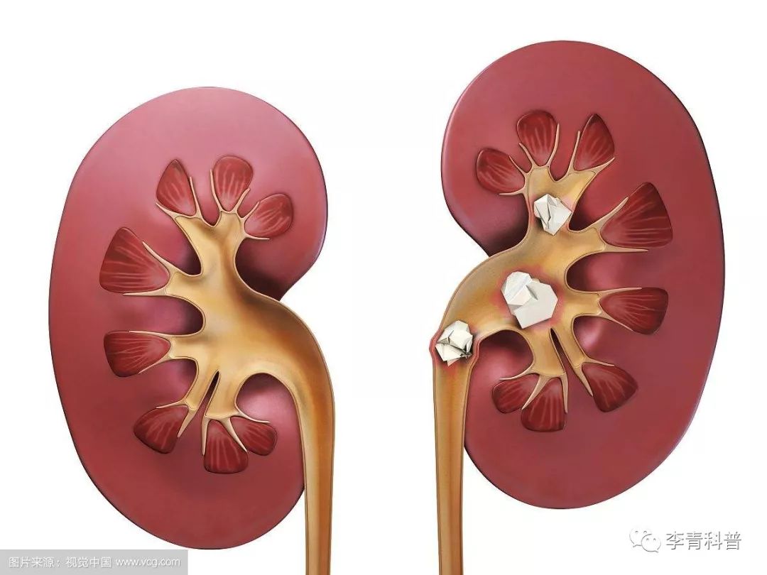 一年内得了好几次肾结石,得了一次肾结石可能永远不复发么