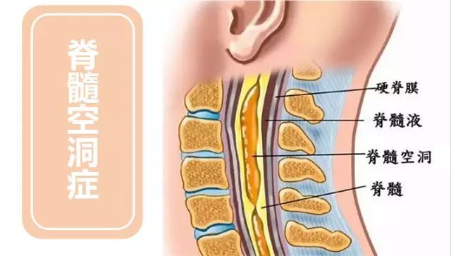脊髓空洞症手术是微创手术吗,脊髓空洞症应该去哪里治疗呀