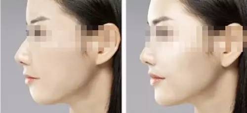 玻尿酸一打就是个无底洞,打玻尿酸现在是不是还挺普遍的