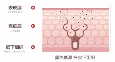 5个祛斑小妙招淡化晒斑雀斑痘印,晒斑痘印怎么消除的最快方法