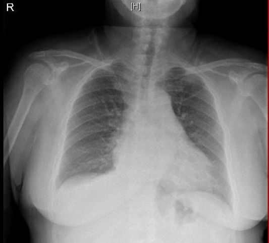 做完消融手术后胸闷憋气,射频消融术后胸闷气短是怎么回事