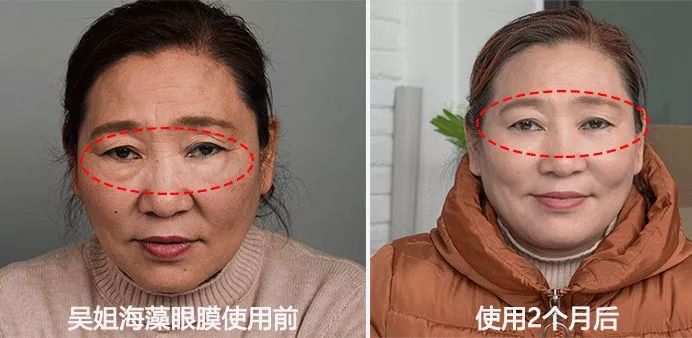 50岁没有眼袋眼纹黑眼圈,60岁去眼袋的最佳方法