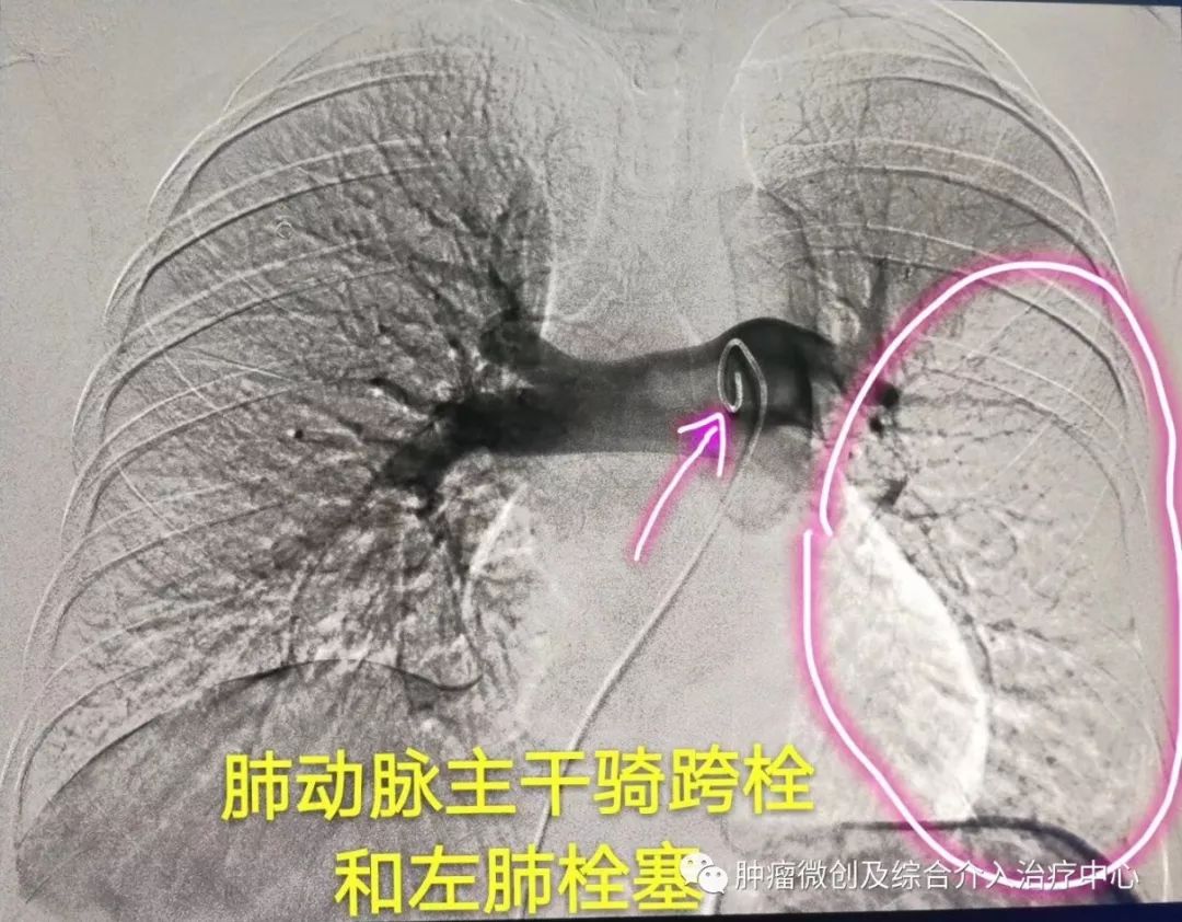 运城市第一医院肿瘤科咋样,运城第一医院治疗肿瘤怎么样