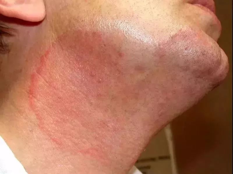 猫癣传染给人怎么办能治愈吗,猫癣给人传染了怎么办