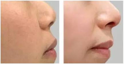 激光美容祛疤的真实性,激光美容真的靠谱吗