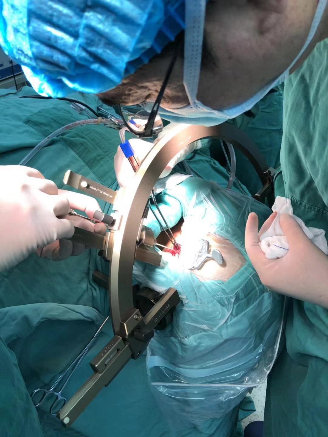 赞！重庆三博江陵医院成功开展脑干占位立体定向活检术！