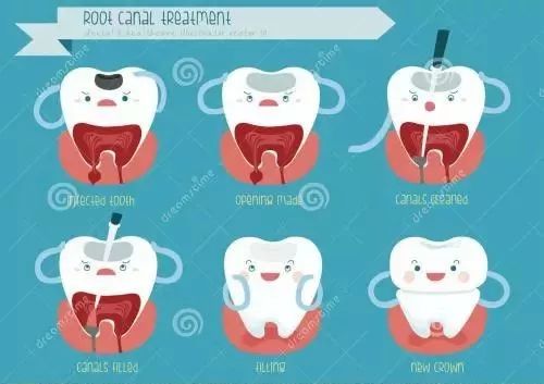 根管治疗加牙冠修复一般多少钱,根管治疗宣教科普视频