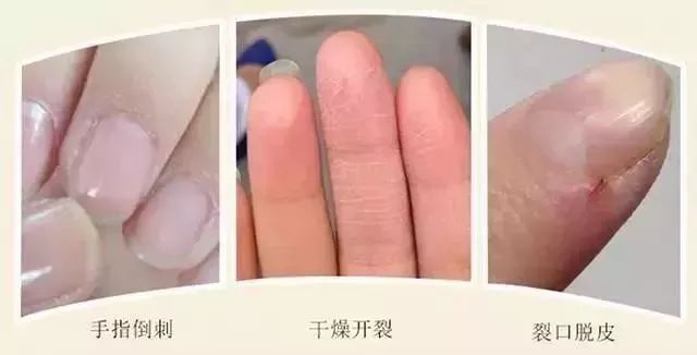 脚后跟干裂修复霜去死皮,脚干裂脱皮修复霜