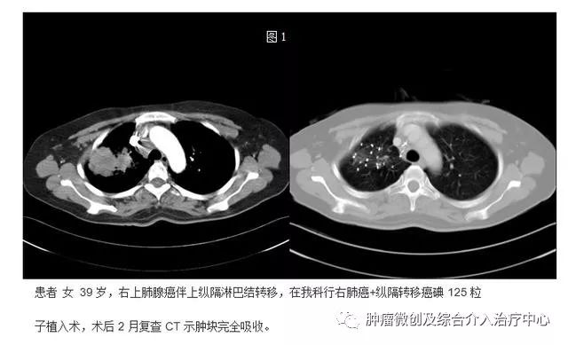 碘125粒子植入术适合哪类肿瘤,碘125粒子植入治癌