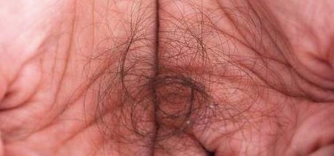 头皮屑洗不掉怎么办有什么方法,头发头皮屑多且大块还结痂有虫